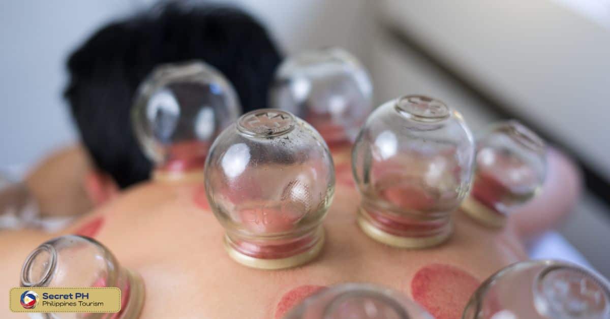 Cupping Therapy